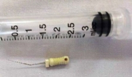 Bé 5 tuổi bị kim lấy tủy rơi vào đường thở khi đang chữa răng